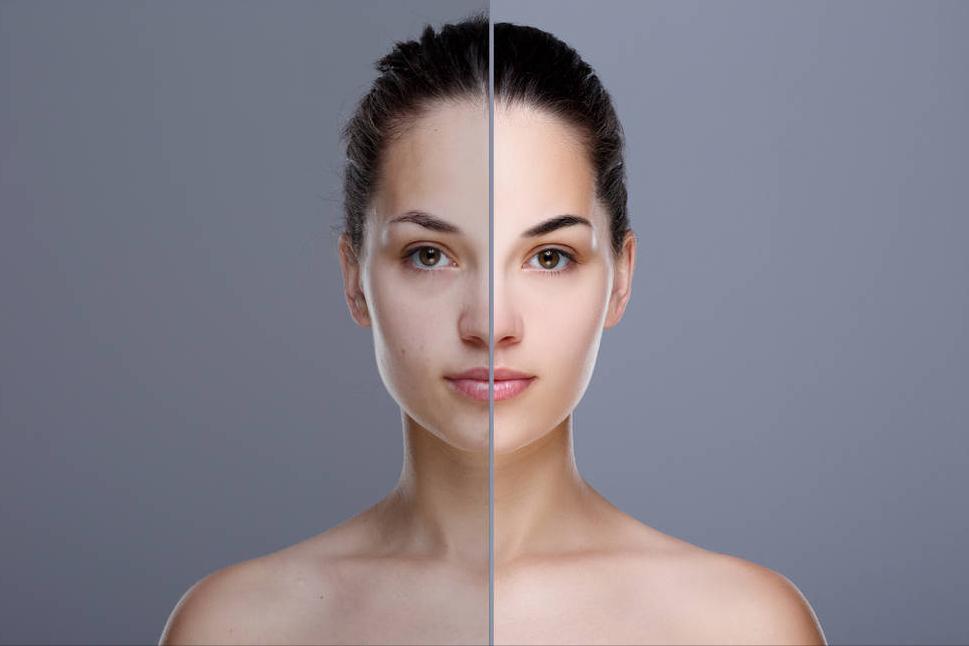 毛孔粗大怎么修复男士,毛孔粗大怎么修复医美