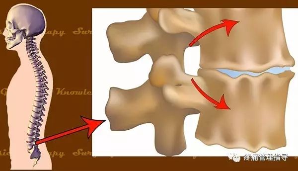 72岁老人腰疼还有骨刺该怎么治疗,老年人骨刺疼痛怎么治疗