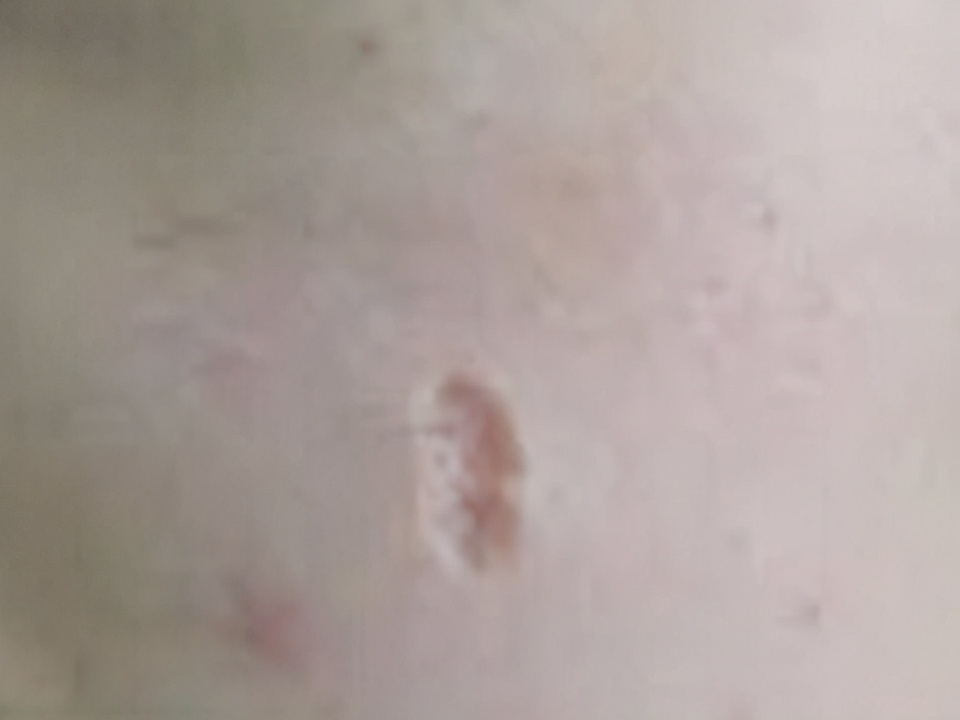 新凹陷疤痕怎么最快恢复,凹陷疤痕能修复平吗