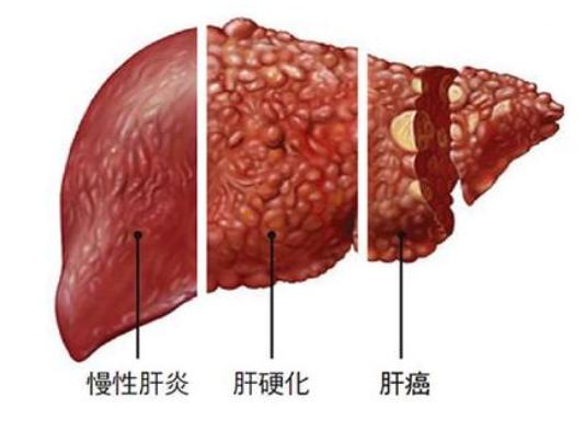 干细胞治疗肝脏疾病，疗效惊人！（内附案例分享）