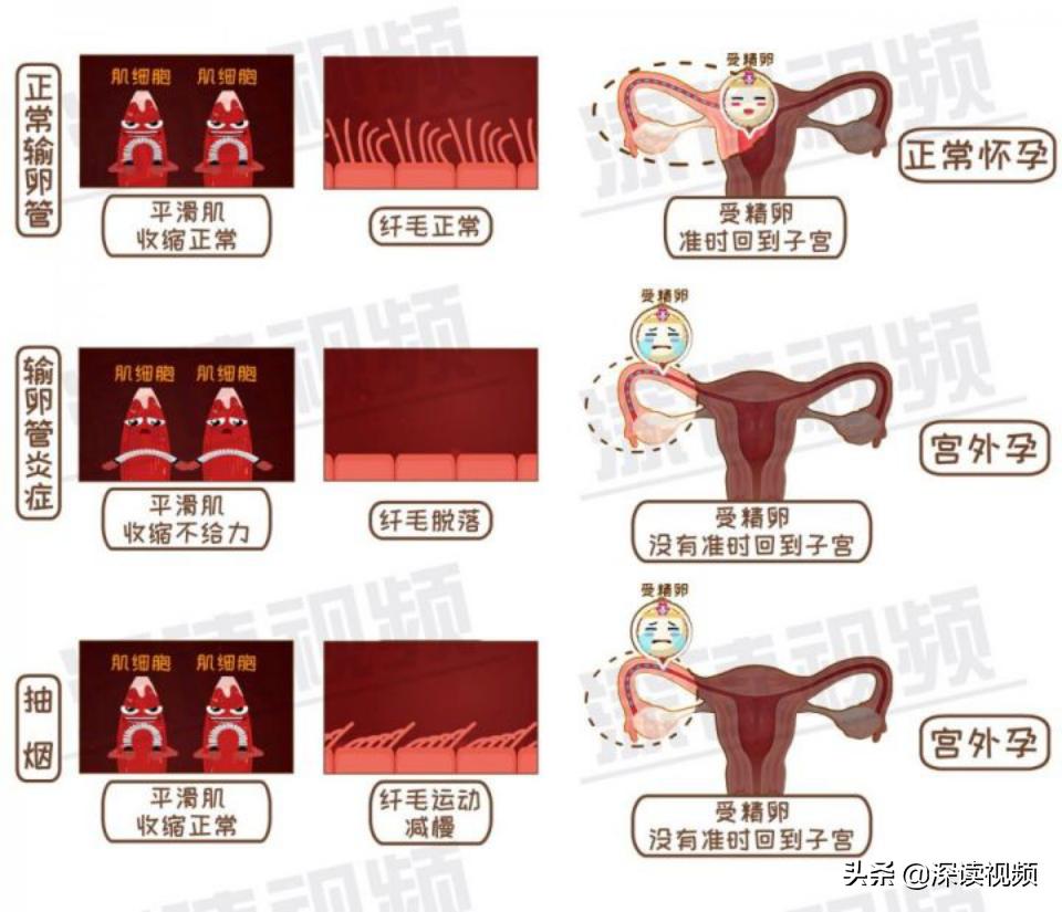 宫外孕一直流血怎么回事,宫外孕是怎么回事呢