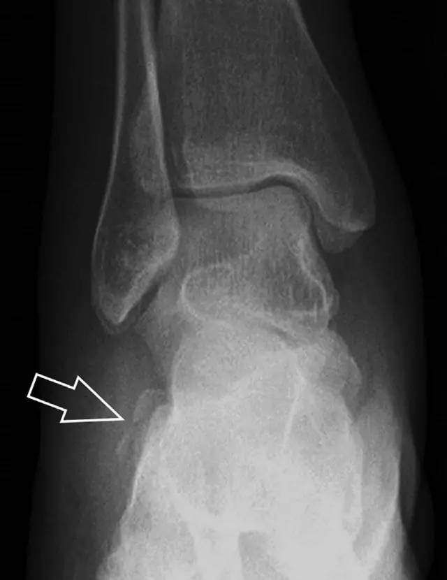 常见的八种骨折,容易漏诊的肩关节骨折