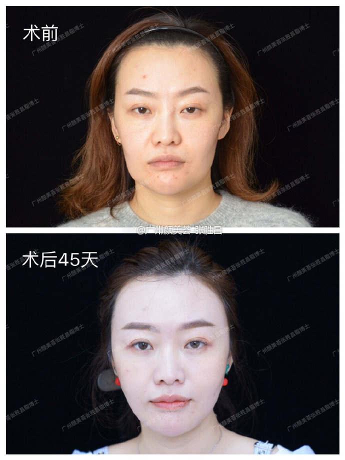 打完瘦脸针怎样快速分解肉毒素,打瘦脸针肉毒素的扩散范围是多少