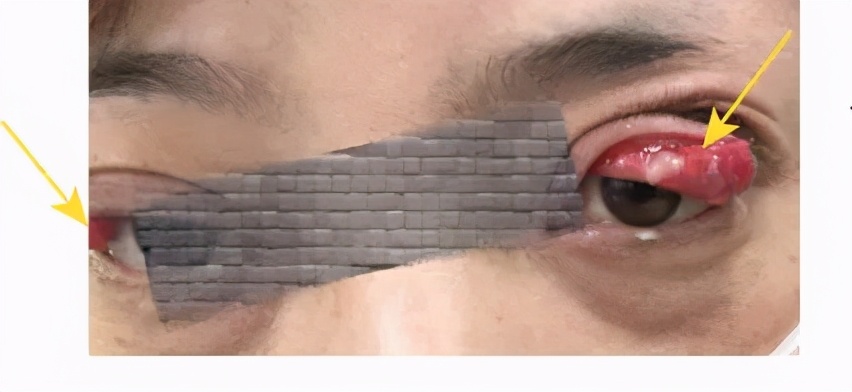 感冒哮喘用药不缓解,吃感冒药诱发哮喘