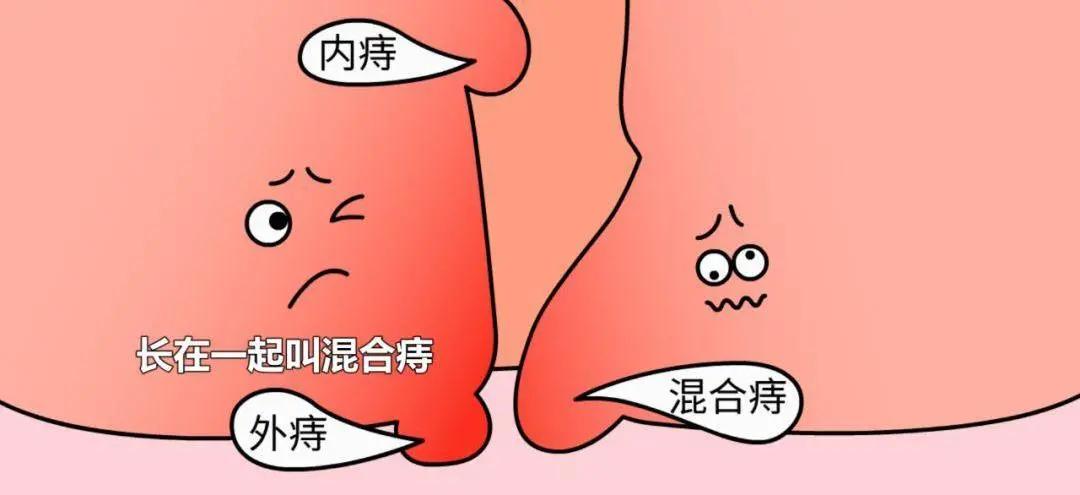 【李解肛肠】第34期|老年人肛门有肿物脱出可能是这两种疾病在作祟