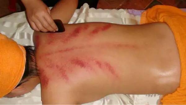 刮痧留下的印,刮痧后的痧怎么消得快