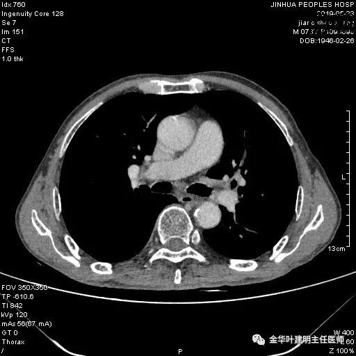 手术引起乳糜胸,有没有做了肺结节手术后是误诊的