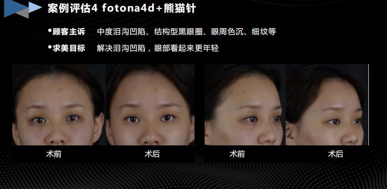 胶生灌养眼周抗衰是什么产品？