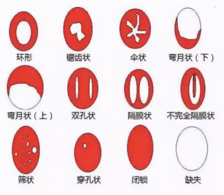 处女膜，其实并不是膜