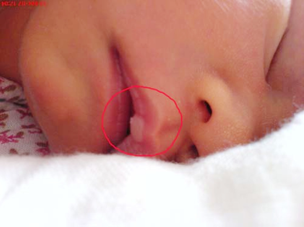 新生儿嘴唇上的奶泡多久可以脱落,新生儿上下嘴唇都有奶泡怎么办