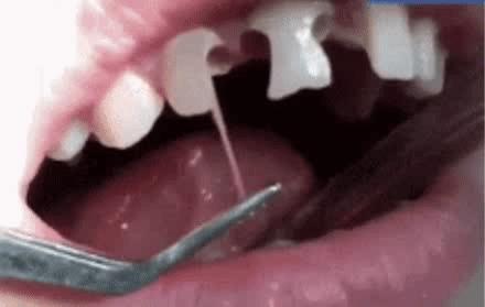 根管治疗可怕,根管治疗很恐怖吗