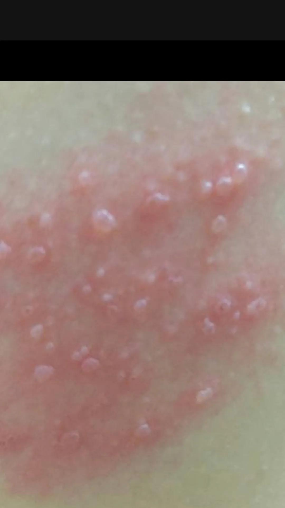 艾灸治疗带状疱疹有奇效,治疗带状疱疹需要多少钱