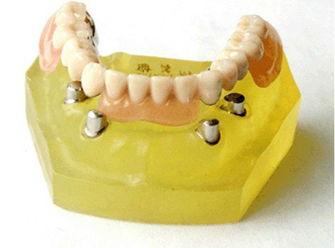 各种假牙价格一览表,假牙十大品牌价格表