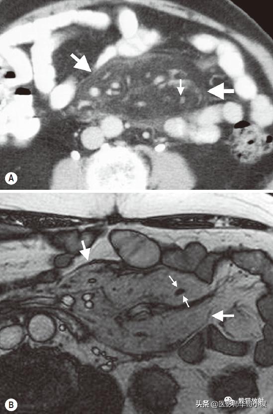 「精品课件」11种腹膜感染/炎症性病变的影像学表现