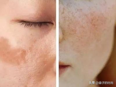 祛斑走过太多的弯路最有效的方法,祛斑最有效方法日晒斑