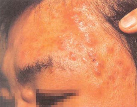 青春痘皮肤病如何治疗好,青春痘怎么治疗最好女学生