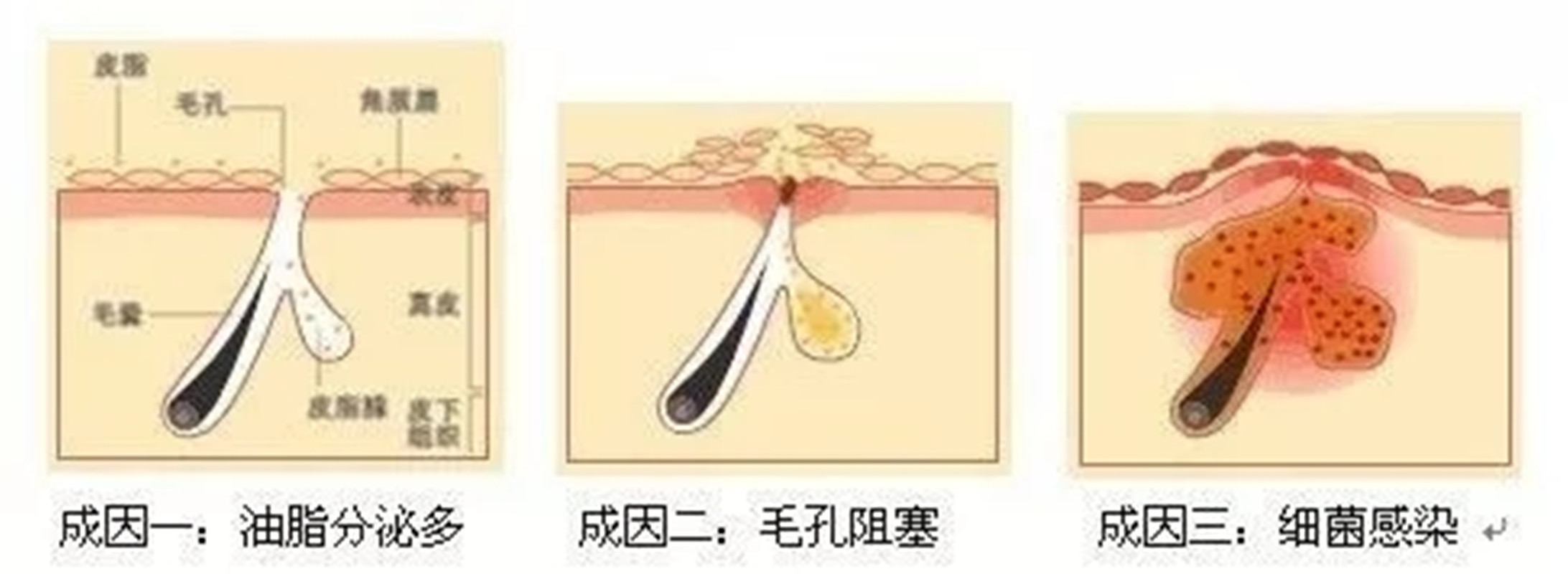 脸一直反复长痘怎么调理,脸部老是长痘痘怎么解决