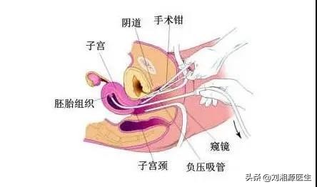 「免疫相关不良妊娠答疑解惑55」——复发性流产