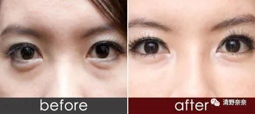 方脸短下巴难看,方圆脸怎么改善脸型下颚线高