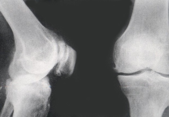 中老年人既患骨质疏松,又有骨质增生,怎么回事呢?