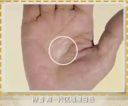 手的10大疾病征兆,手诊10种常见病从手上就能看出来