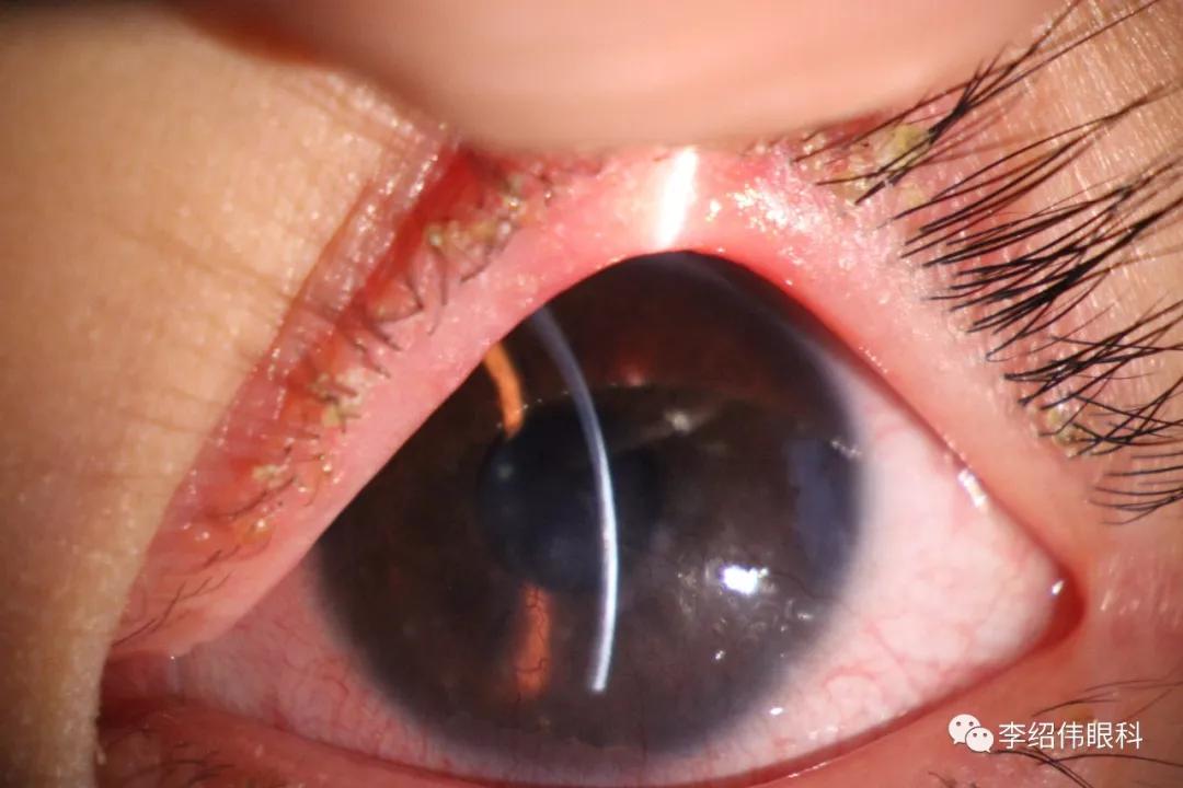 眼睛肿了会是感染新型肺炎了吗,新冠肺炎引起的眼睛红怎么治疗