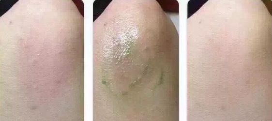 蚊虫叮咬后能用烫伤膏吗,烫伤烧伤瘙痒蚊虫叮咬用什么药膏