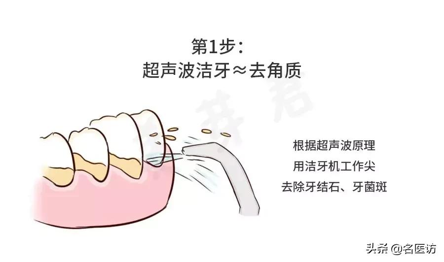 洗牙攻略,洗牙全攻略