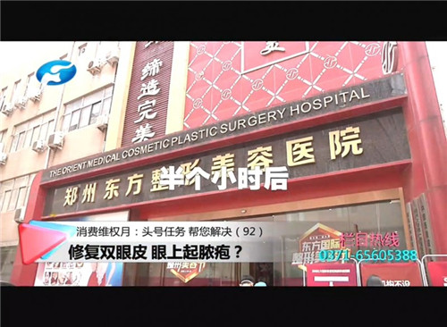 割双眼皮线没有拆干净出脓包了,郑州东方整形医院双眼皮成功案例