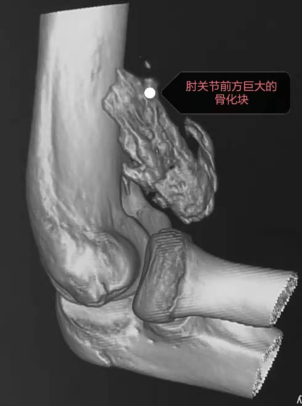 儿童胳膊肘手术后伸不直怎么恢复,手术后胳膊伸不直能恢复正常吗