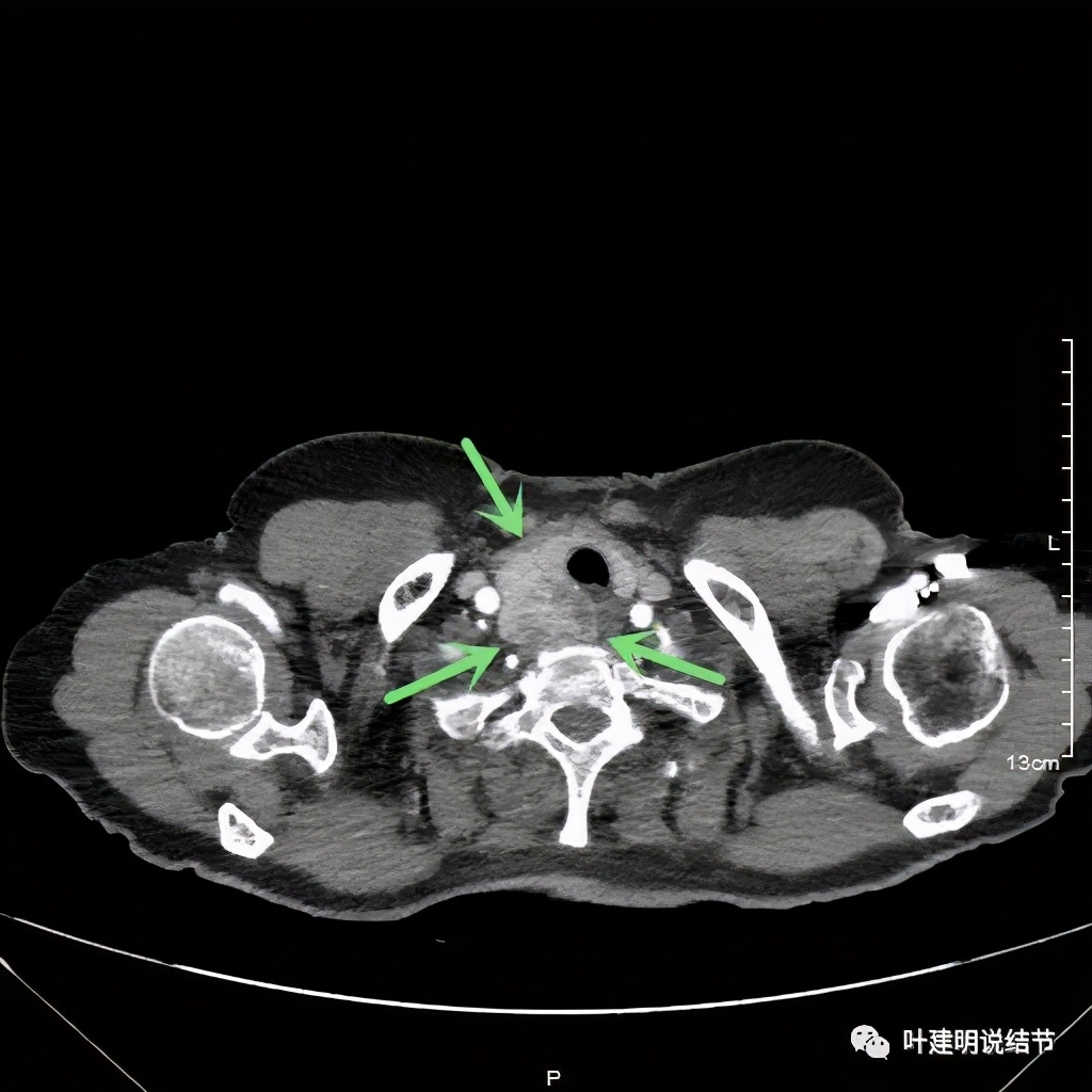 胸部高分辨ct检查注意事项,胸部ct扫描有没有危害