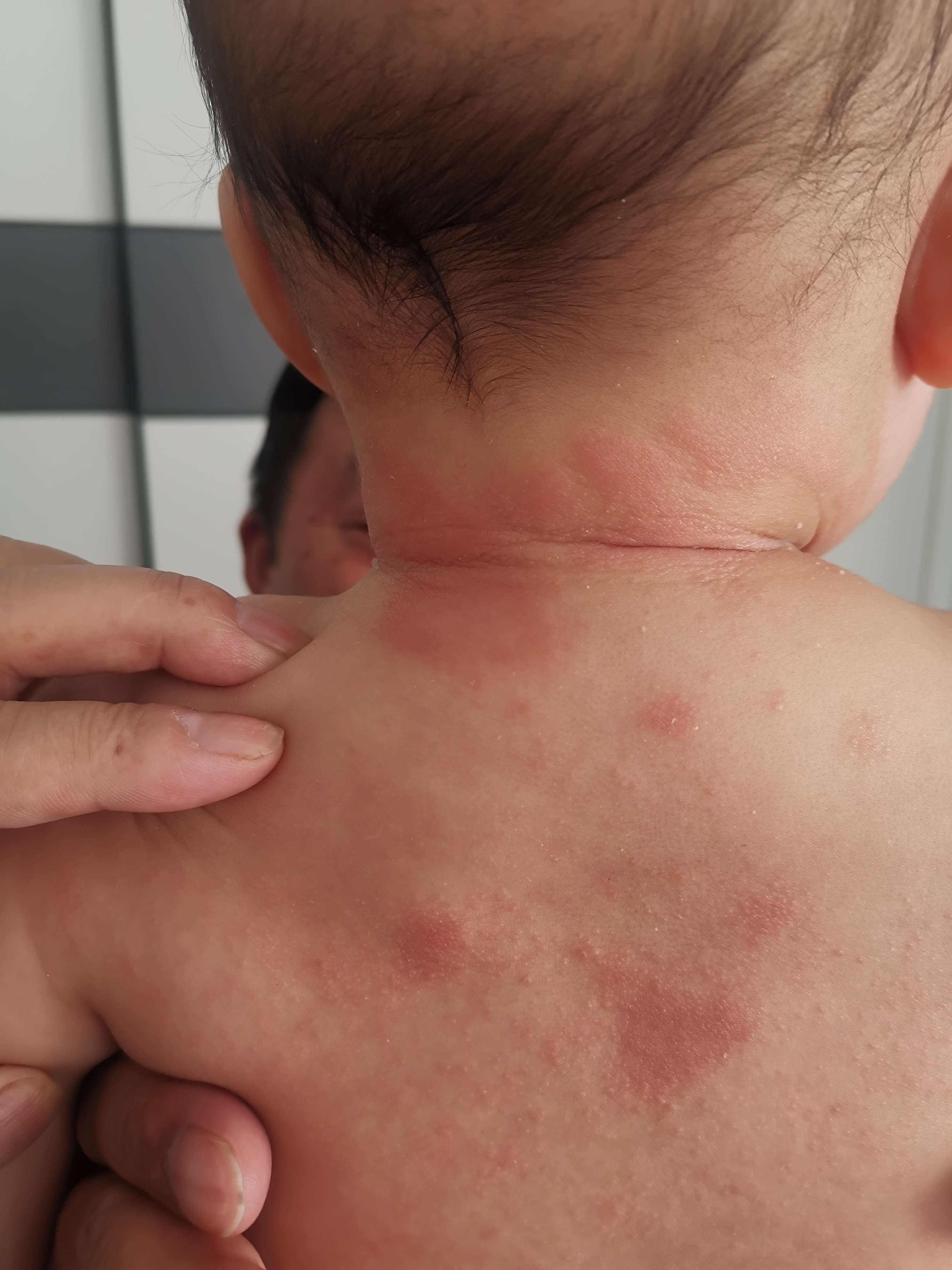 孩子湿疹反复内调,孩子湿疹反反复复怎么根除