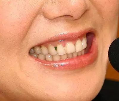 吃东西老塞牙，牙缝里有臭味！怎么办？