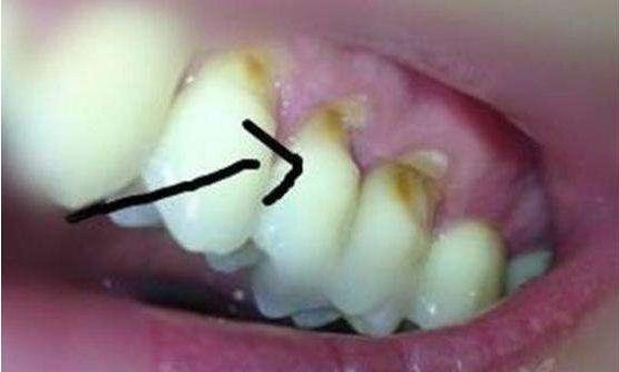 刷牙感觉牙齿松动怎么回事,由于刷牙太猛导致牙齿损伤怎么办