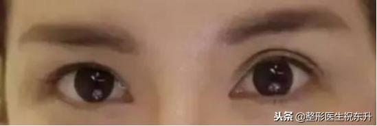 割双眼皮后怎样可以尽快完全恢复,割双眼皮的危害老了以后会怎样