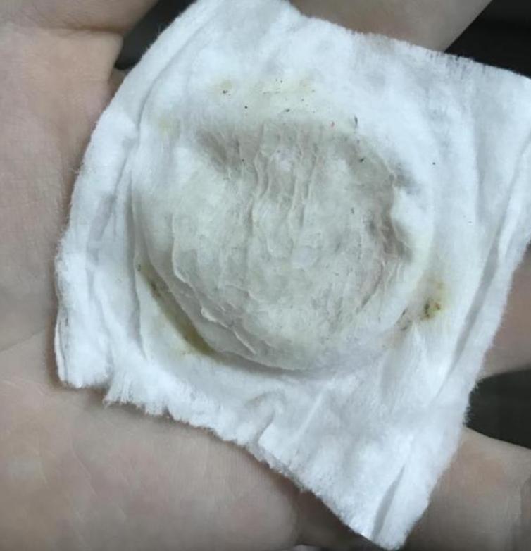 一些注射了玻尿酸的女人,那些做医美的女人最后怎么样了