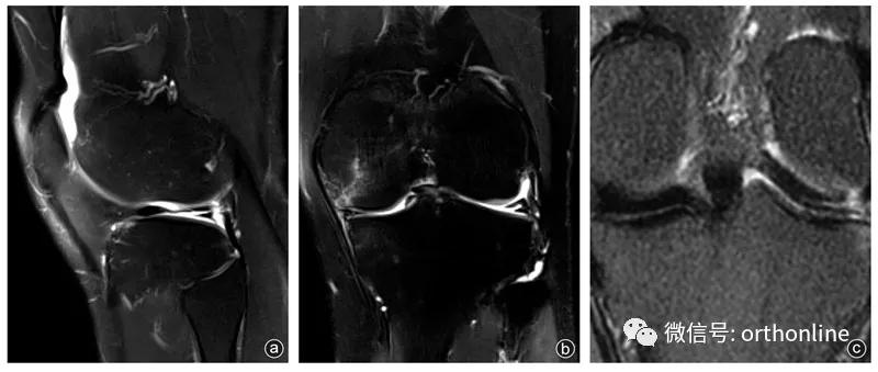 关节镜下治疗症状性Wrisberg韧带型盘状半月板的临床疗效