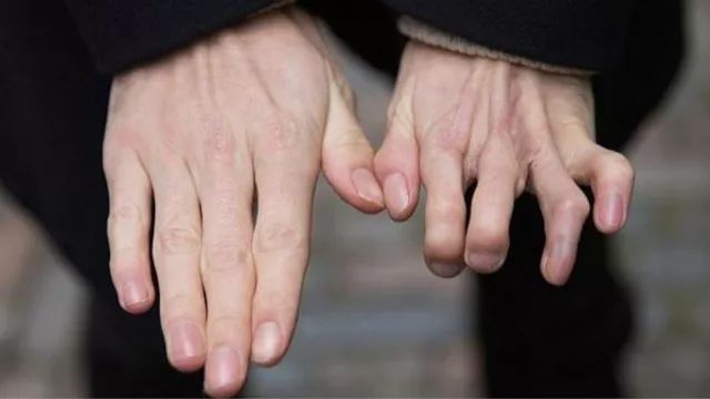 外国帅哥患波兰综合症，移植脚趾到手上，网友表示：看脸就行！