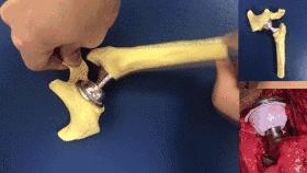 髋关节置换如何抗感染,骨科髋关节置换术后注意事项