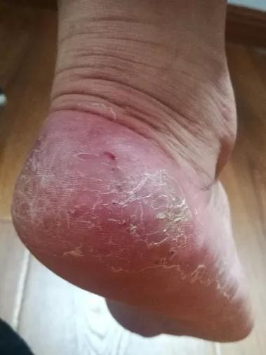 角质去除小妙招,角质层真菌怎么消除最快