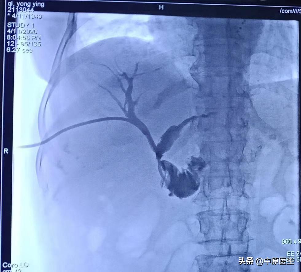 团队工作：老太太患黄疸规范治疗后仍高烧，转到介入科很快治好了