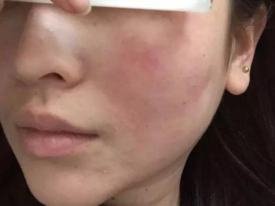 油敏干敏是什么症状,如何区别干敏和油敏