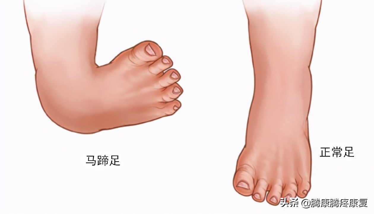 下肢常见神经损伤后表现