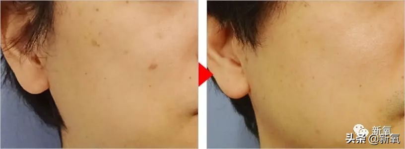 宋祖儿雀斑造型美到窒息,宋祖儿脸上的雀斑一清二楚