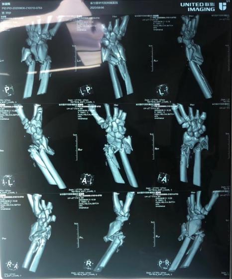 手臂离断再植,手臂断离再植