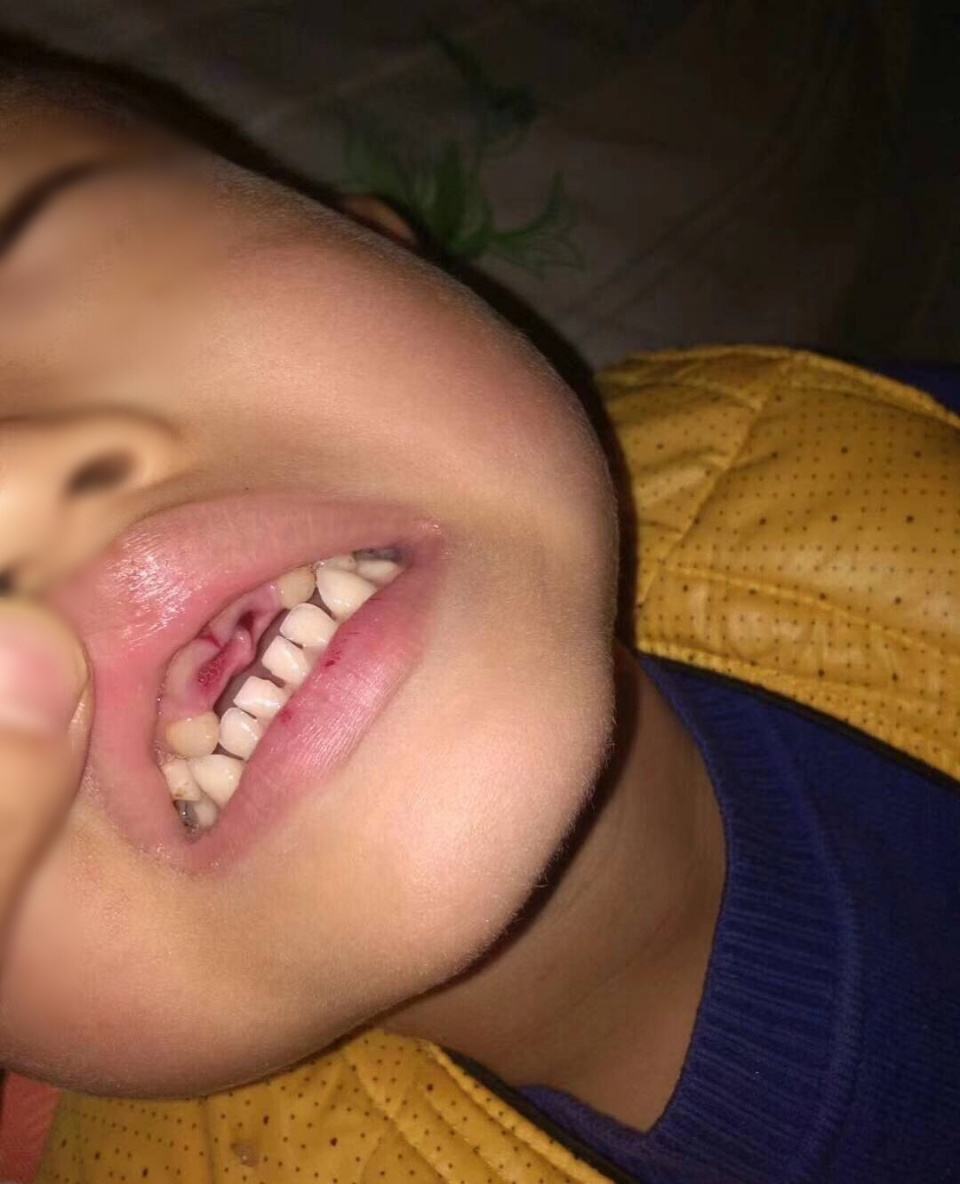 小孩牙摔断了怎么办,孩子牙摔断了有什么预兆