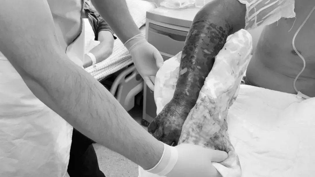 抗洪战士被毒蛇咬了,被剧毒蛇咬伤医生救援