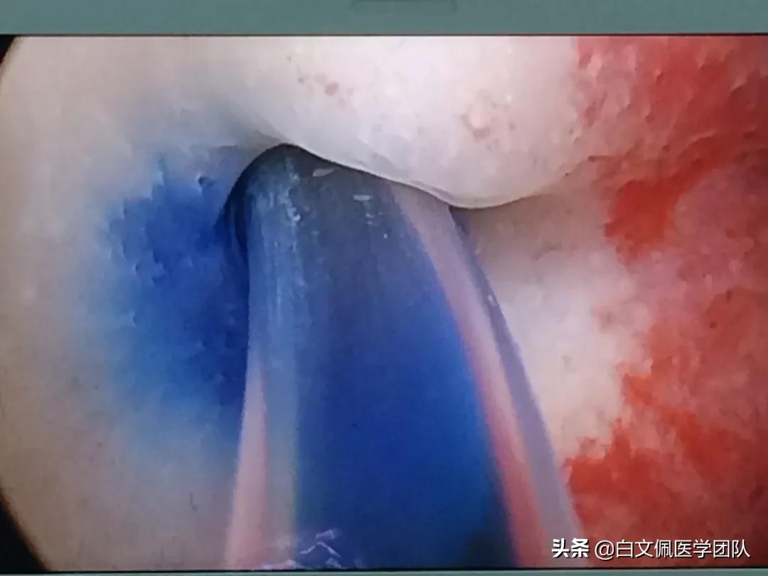 治疗输卵管性不孕重点在“通”