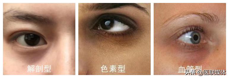 什么才是去除黑眼圈的有效方法,改善黑眼圈与去黑眼圈的区别