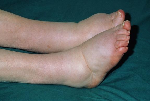 脚部动脉有血栓是什么症状,血栓形成时脚上会有4个症状